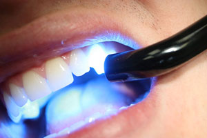 laser teeth whitening and fillings